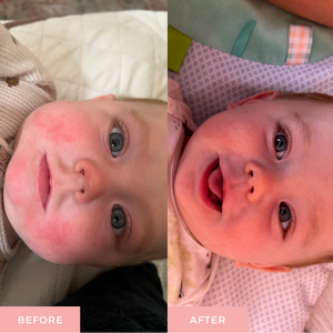 before and after images of baby lotion sensitive skin