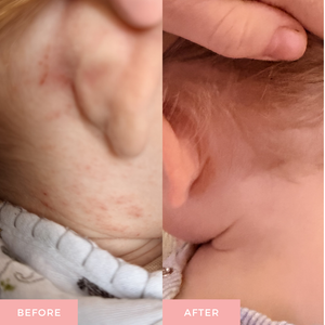 Before and after comparison close-up of a baby's ear and neck area, showing red rash or bumps on the left and clearer skin on the right, with a hand pulling back hair in the after photo.