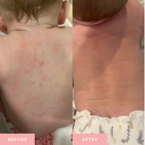 A side-by-side before and after comparison of a baby's back, showing red, irritated skin on the left and clear, healed skin on the right.