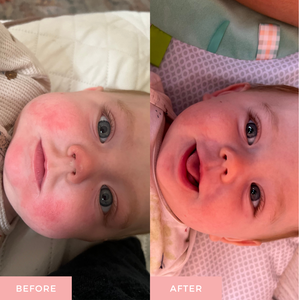A side-by-side before and after comparison of a baby's face, showing skin improvement. The left 'BEFORE' image shows the baby's face with red cheeks, while the right 'AFTER' image shows the cheeks are significantly smoother and clearer.