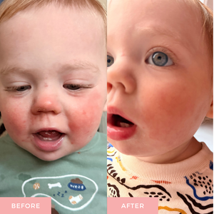 Before and after comparison of a child's face with a visible difference.