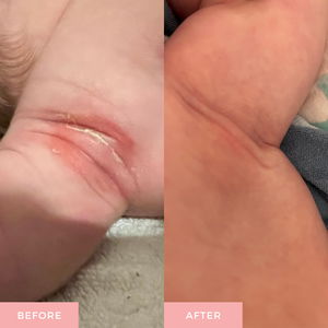 A side-by-side before and after comparison of a baby's underarm, showing a red rash on the left and a smooth, healed underarm on the right.